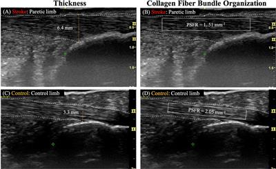 Achilles tendon morphology adaptations in chronic post-stroke hemiparesis: a comparative analysis with neurologically intact controls